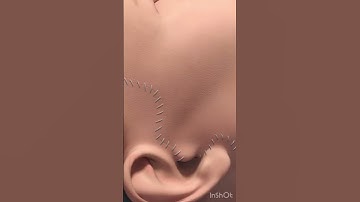 Facelift Procedure- Medical Animation Video in 3D - #health #youtubeshorts