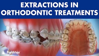 Extractions in Orthodontic Treatment  Is it necessary? ©