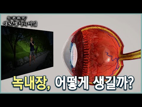 녹내장은 어떤 질환 KBS 20220831 방송 