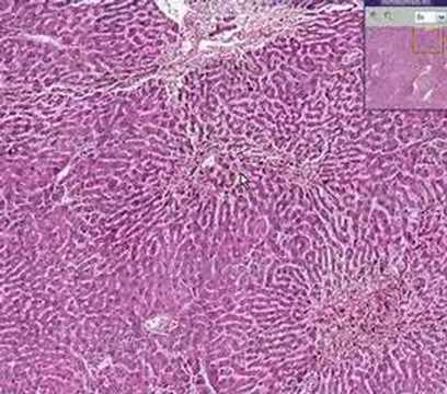 Histopathology Liver --Chronic passive congestion with hemor - YouTube