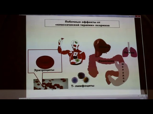 Современные методы лечения псориаза