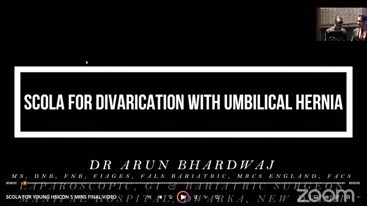 SCOLA for divarication with umbilical hernia - YouTube