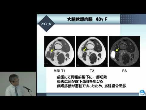 悪性骨軟部腫瘍（肉腫） “肉腫の診断と治療 －大切な基本と新しい知見－”　川井 章