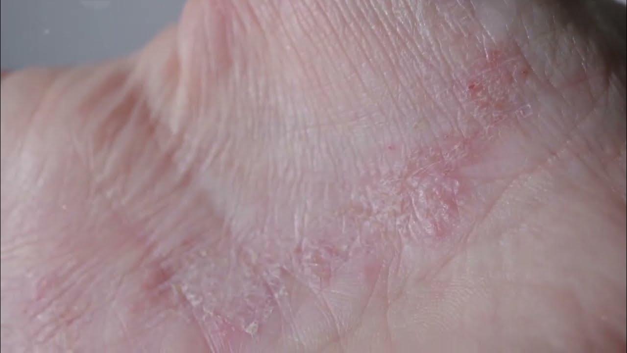Eczema causes and triggers of eczema youtube