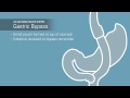 Weight-Loss Surgery: Gastric Bypass Animation