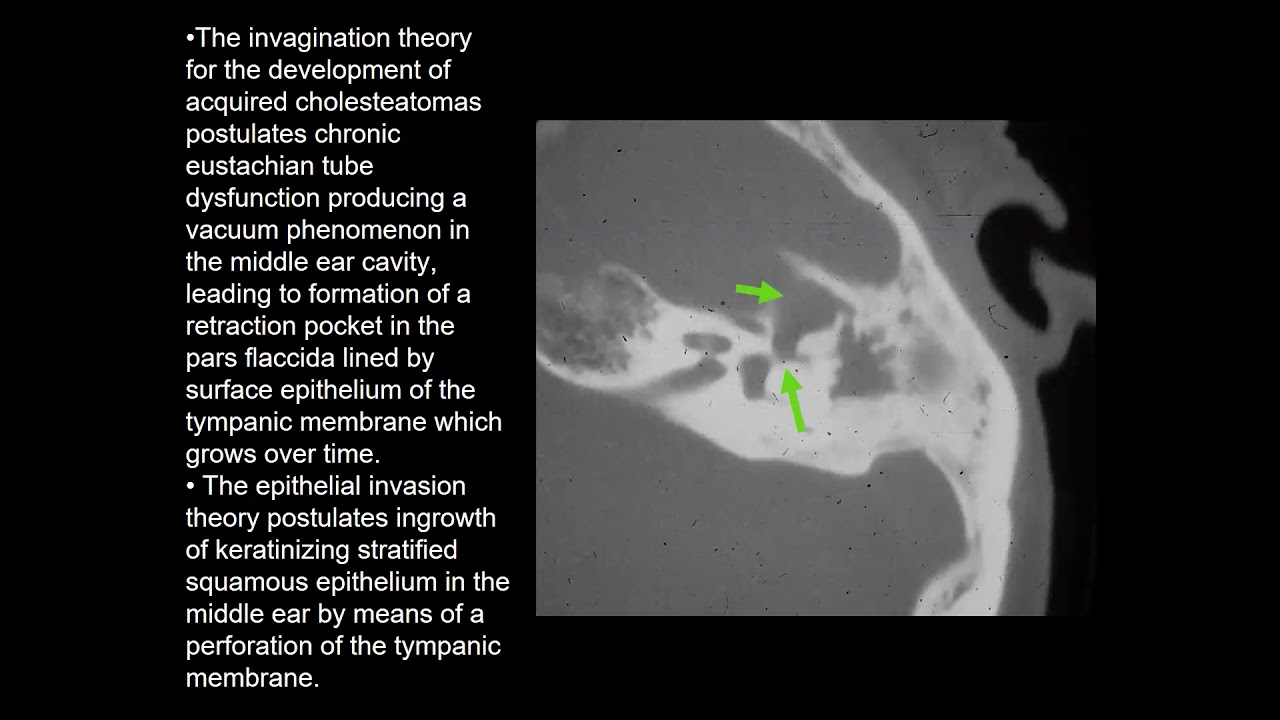 Cholesteatoma Summary Middle Ear MRI MRI Online YouTube