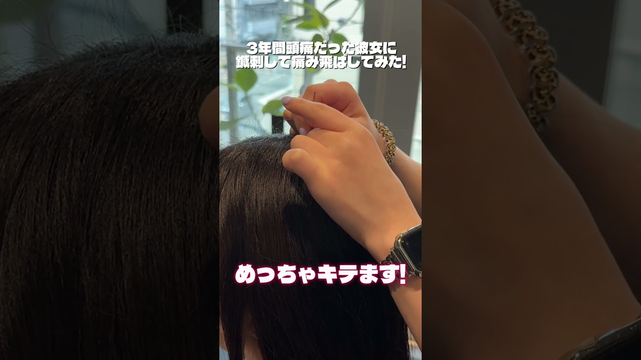 頭のてっぺんに鍼で刺して頭痛取ってみた! #鍼治療