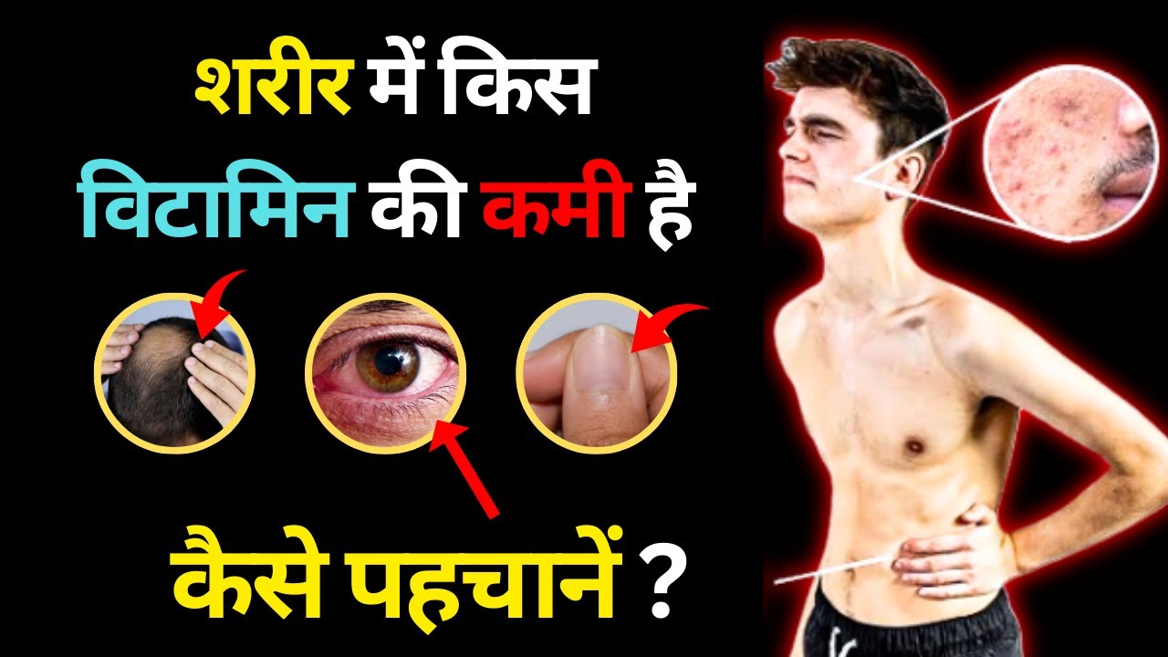 Vitamin D Ki Kami Se Kya Hota Hai विटामिन डी की कमी होने पर लक्षण