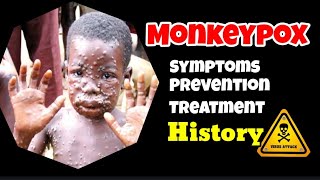 Monkeypox- History, Symptoms, prevention, Treatment.