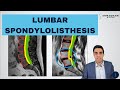 Lumbar Spondylolisthesis - Anatomy, Symptoms, Causes, Treatments and more!