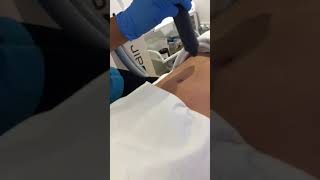 Body Sculpt-localised cryotherapy combined with deep tissue massage - Step 1 | Cryojuvenate