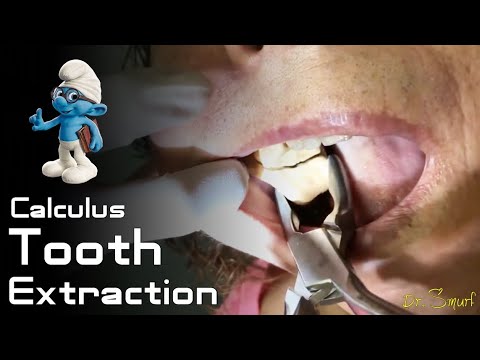Video: Odstranjevanje agresivnih zob