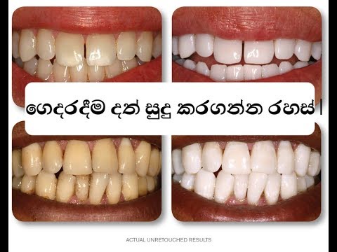 sinhala-ගෙදරදීම-දත්-සුදු-කරගන්න-රහස්-|-teeth-whitening-secret,-home-remedy
