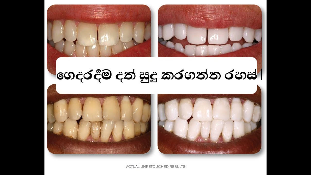 SINHALA ගෙදරදීම දත් සුදු කරගන්න රහස් TEETH WHITENING SECRET, HOME
