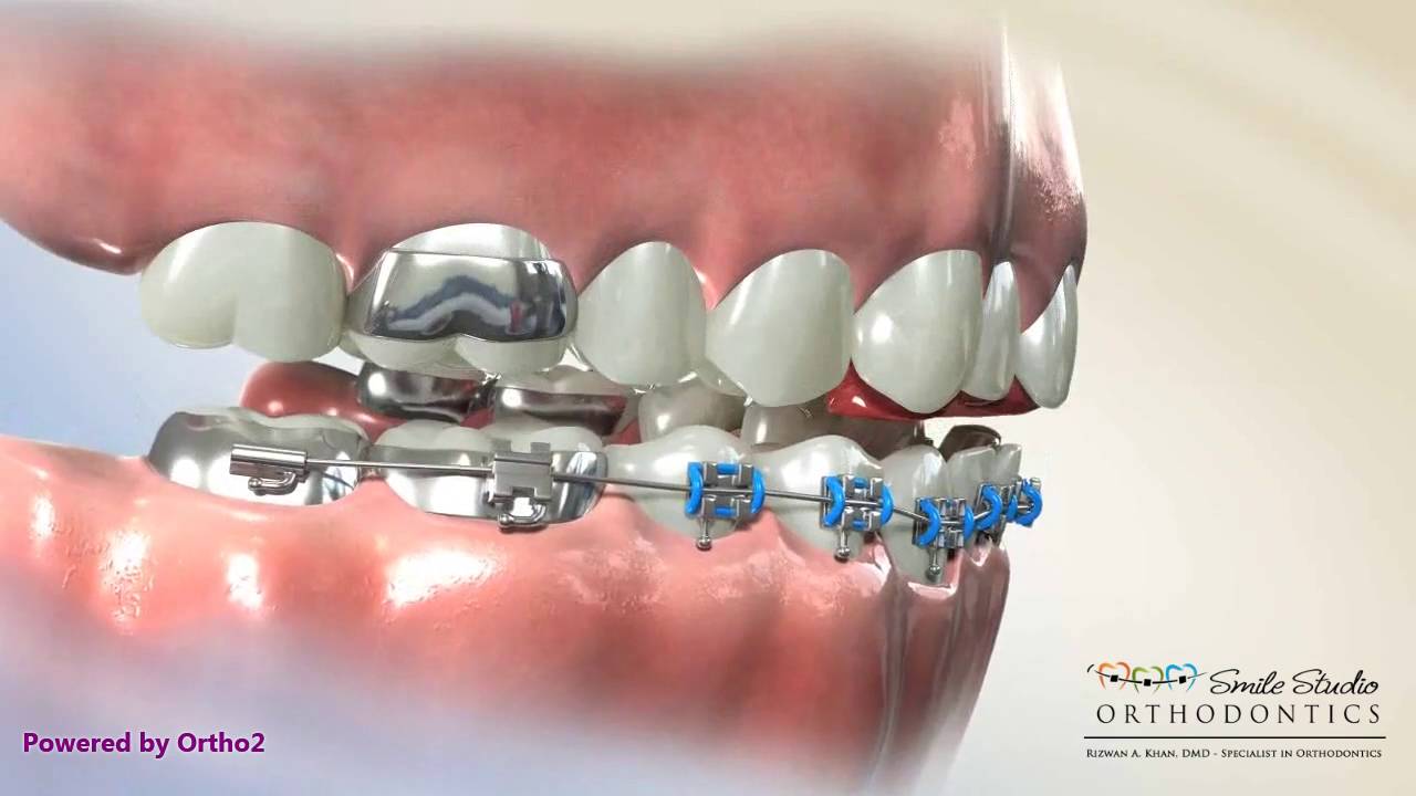 Fixed Bite Plate for Breakage Orthodontic Treatment YouTube