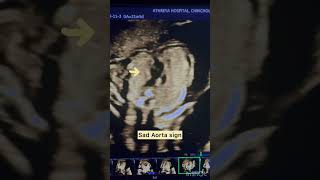 Transposition of the Great Arteries (TGA)” fetal echo findings