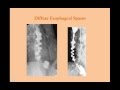 Esophageal Disorders (old version, with sound) - CRASH! Medical Review Series