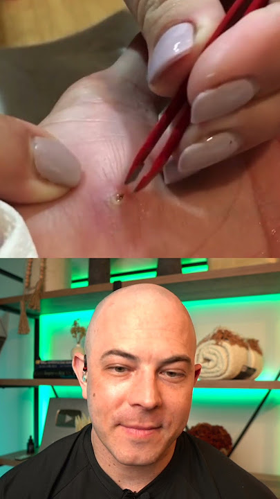 Derm reacts to super satisfying infected splinter removal! #dermreacts #doctorreacts #splinter