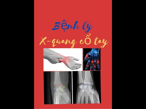 Video Bệnh lý X-quang cổ tay và đầu xa xương cẳng tay - youtube