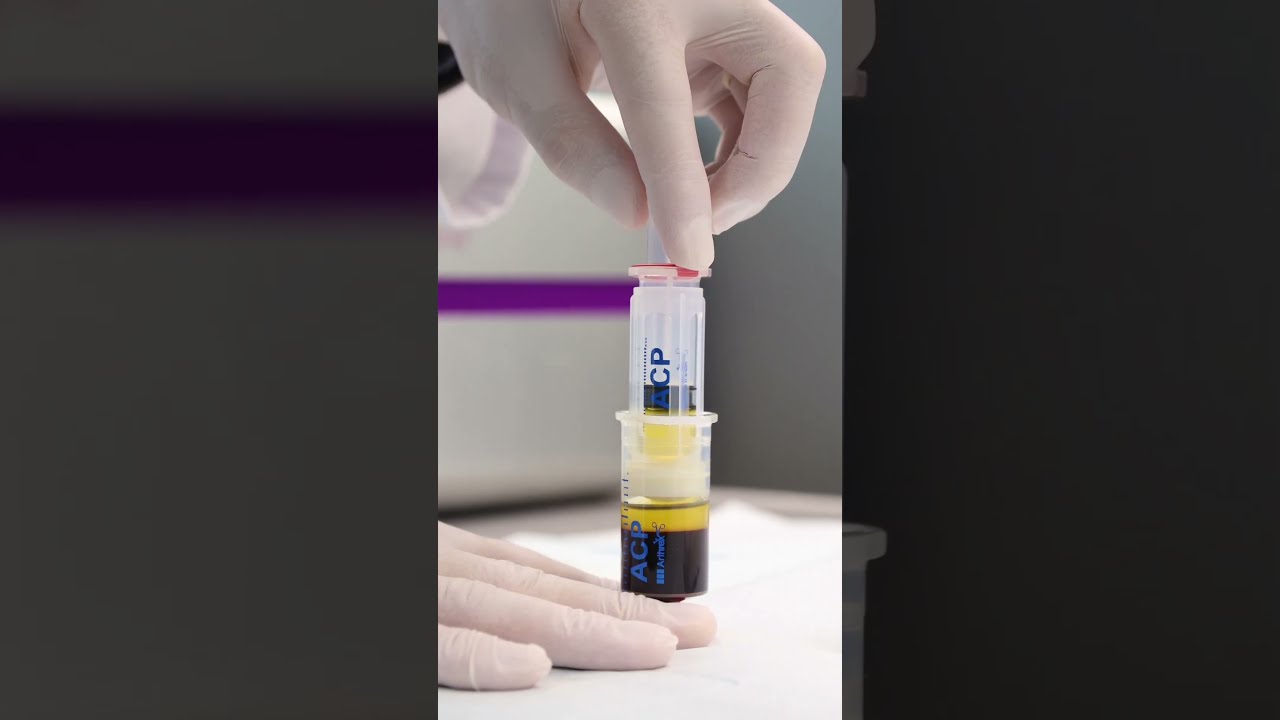 Le Plasma Riche en Plaquettes agit sur la régénération des tissus et la stimulation des cheveux