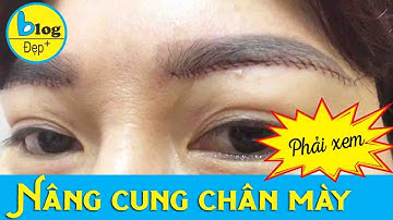 Tất cả giải đáp về nâng cung chân mày cho những ai đang cần