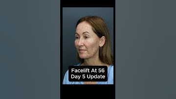 Facelift At 56 - Day 5 Update (Interview) #facelift