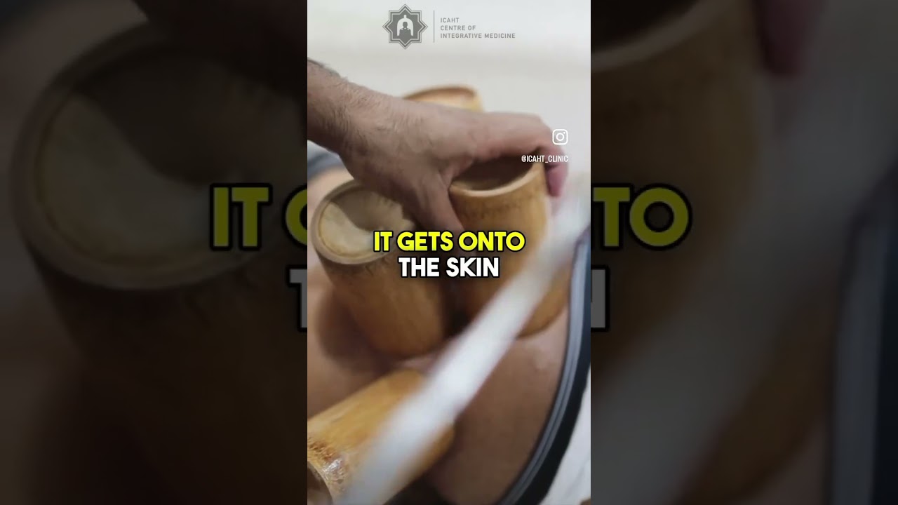 HOW TO... Fire Cupping