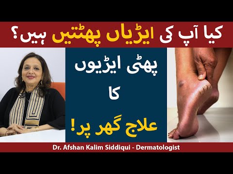 Phati Ariyan Tips In Urdu | Cracked Heels Treatment | Phati Heels Ka Ilaj | Cracked Heels Remedy