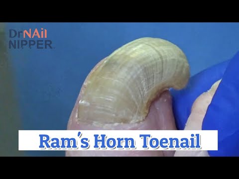 Video: Onychogryphosis (Ram's Horn Nails): Príčiny A Liečba