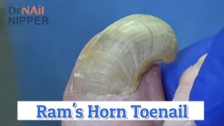 Ram's Horn Toenail (2020)