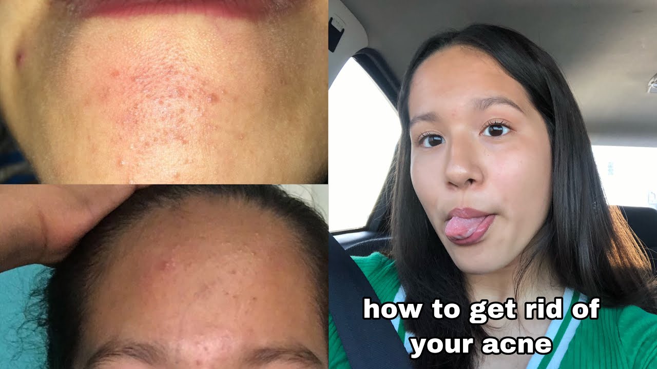 how i got rid of my acne in 1 month (skin care routine) - YouTube