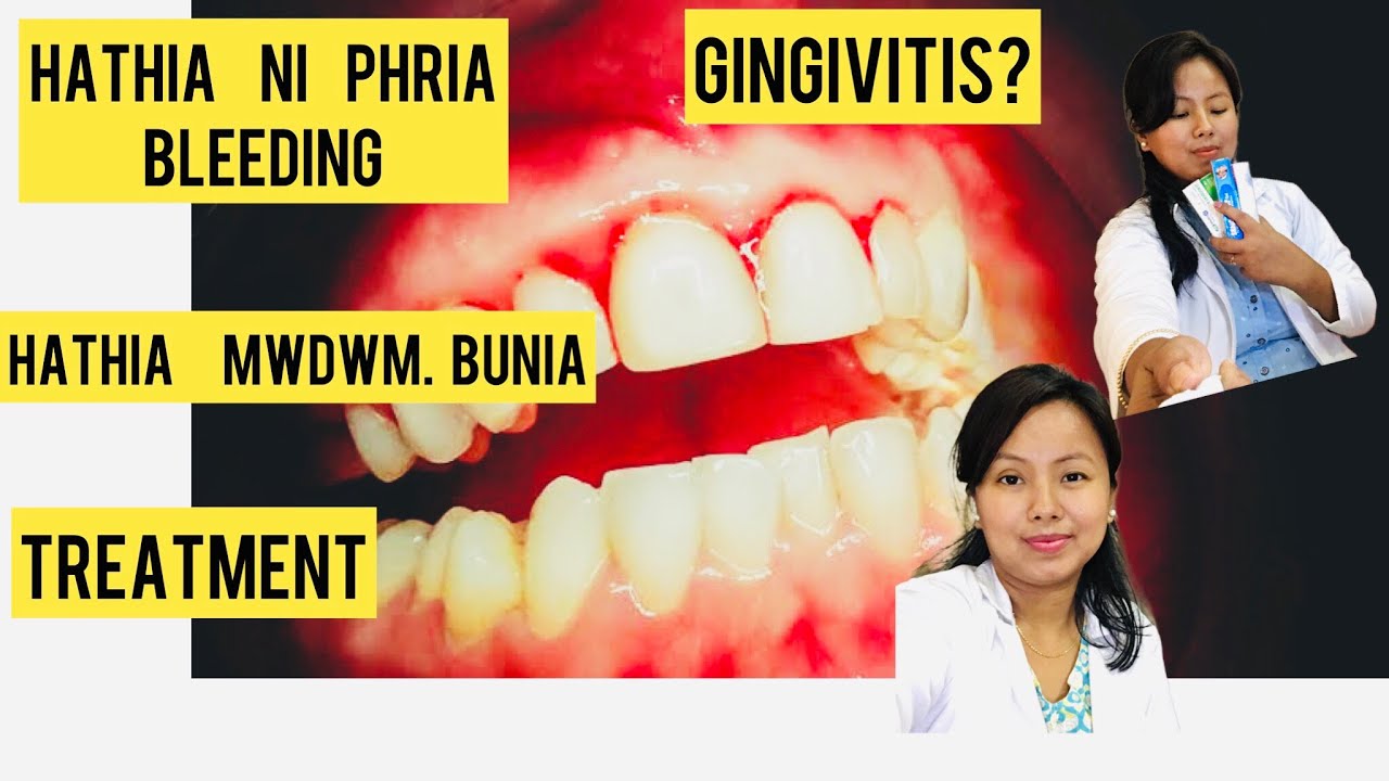 Gingivitis /Bleeding from gums/Home remedy / treatment YouTube