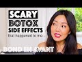 I almost RUINED my face!!! | Botox Masseter