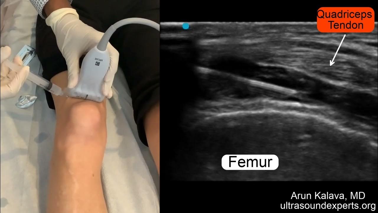 Ultrasound Guided Intraarticular Knee Injection YouTube
