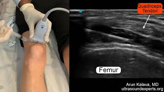 Ultrasound Guided Intra-Articular Knee Injection