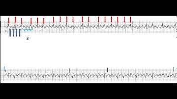 Atrial flutter with variable conduction