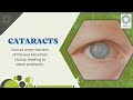Cataract