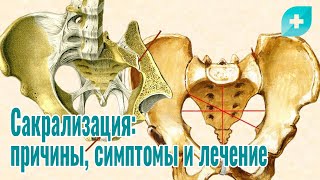 картинка: Сакрализация: причины, симптомы и лечение