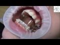 see how we put dental braces..كيفية تركيب تقويم الأسنان