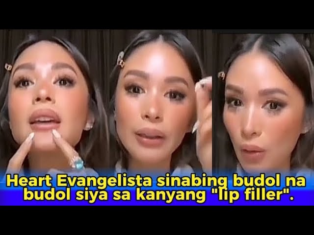 Heart Evangelista trauma ang inabot matapos magpalagay ng "lip  filler".|Heart lip filler.