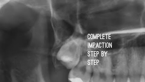 Complete Bony Impaction Third Molar Extraction Video