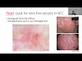 Advanced dermoscopy pearls beyond the basics veronica shi md