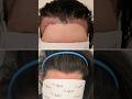 The MOST NATURAL Female Hair Transplant? Rate 0/10