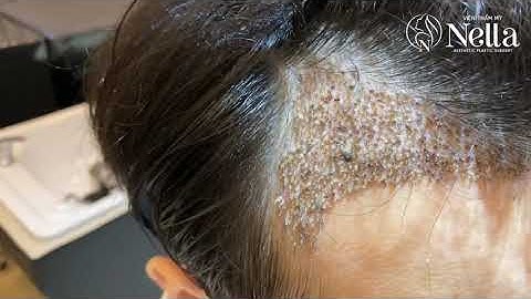 CẤY TÓC TỰ THÂN TẠI NELLA