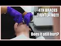 4th BRACES tightening in CALIFORNIA! How have things changed?