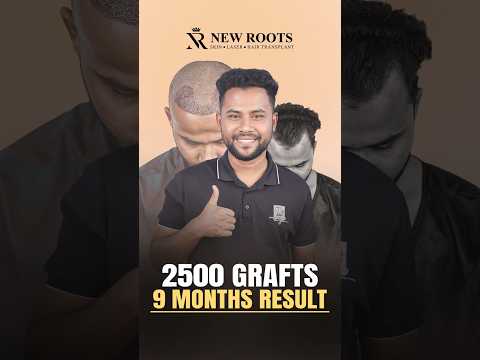 Hair Transplant in Bangladesh (2500 Grafts Result) | Bangla #hairtransplant #bangladesh #shorts