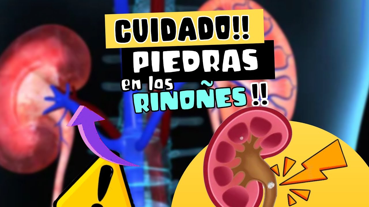 CUIDADO ⚠️ ¿PIEDRAS EN LOS RIÑONES? ¿QUÉ ES LA LITIASIS RENAL? - YouTube