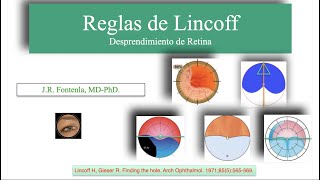 Reglas De Lincoff Desprendimiento De Retina