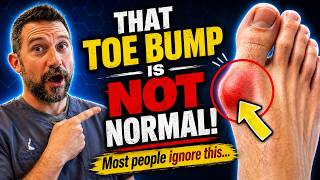 Bunion Pain? Causes, Symptoms &amp; Treatment Options Explained by Dr. Drew Taft