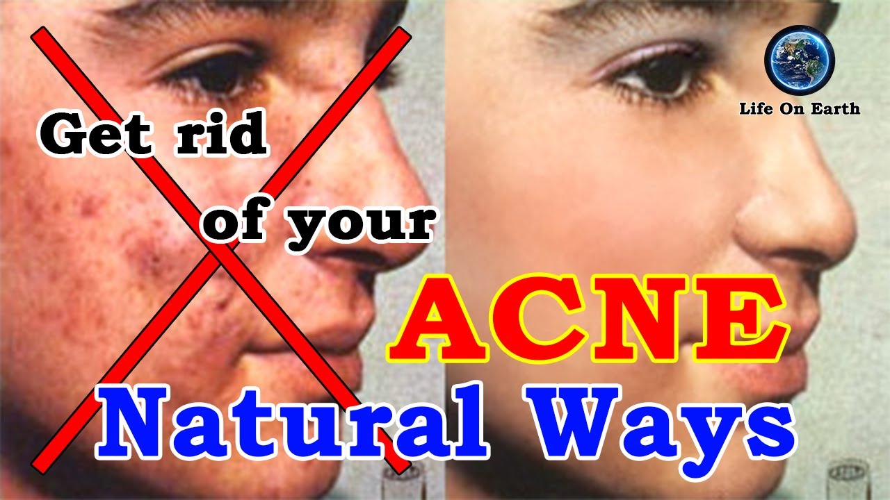 Life On Earth - How to deal with your acne in natural ways.